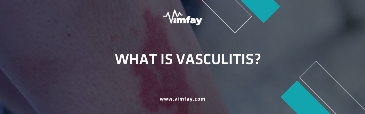 What Is Vasculitis