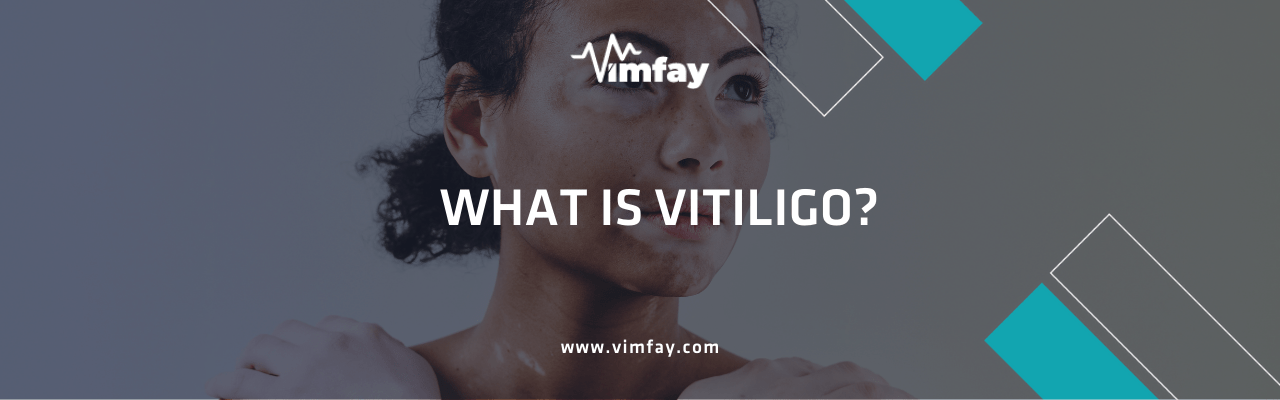 What Is Vitiligo