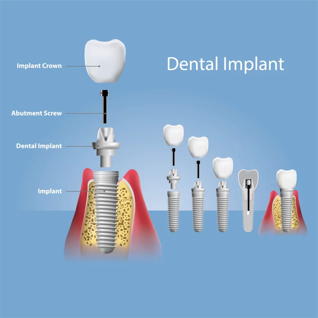 Dental Implants In Turkey 2023 13 1