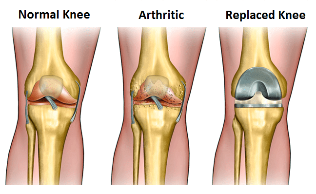 Knee Replacement Surgery 3 2336770