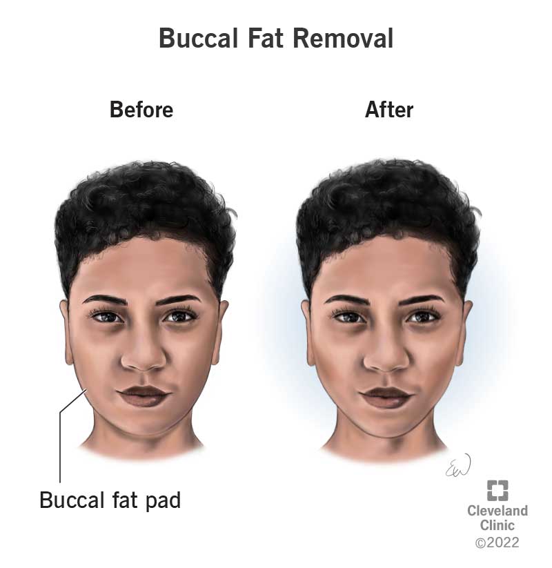 Bichectomy In Turkey, Prices 2023 2 23396 Buccal Fat Removal