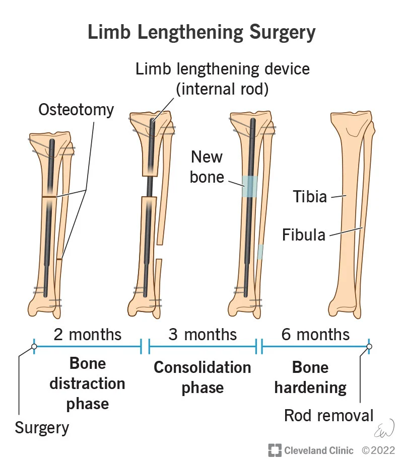 Length Extension Surgery In Turkey 2023 3 24316 Limb Lengthening Surgery