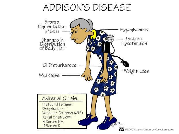 Addison'S Disease, Symptoms And Treatment In Turkey 2023 8 Addisons Disease