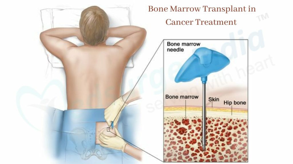 Marrow Transplant 5 Bone Marrow Transplant In Cancer Treatment