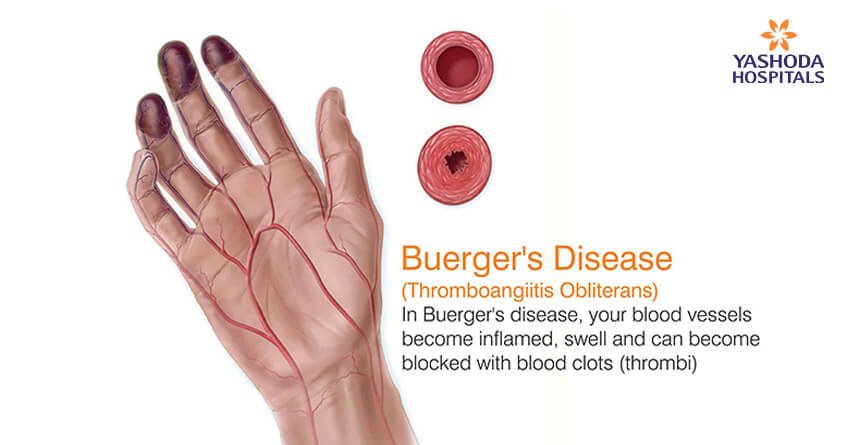Buerger'S Disease 1 Buergers Disease Thromboangiitis Obliterans