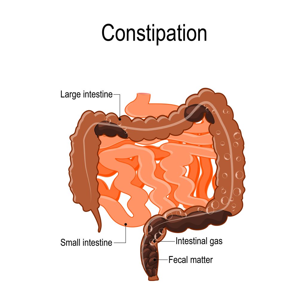 Constipation 4 Constipation
