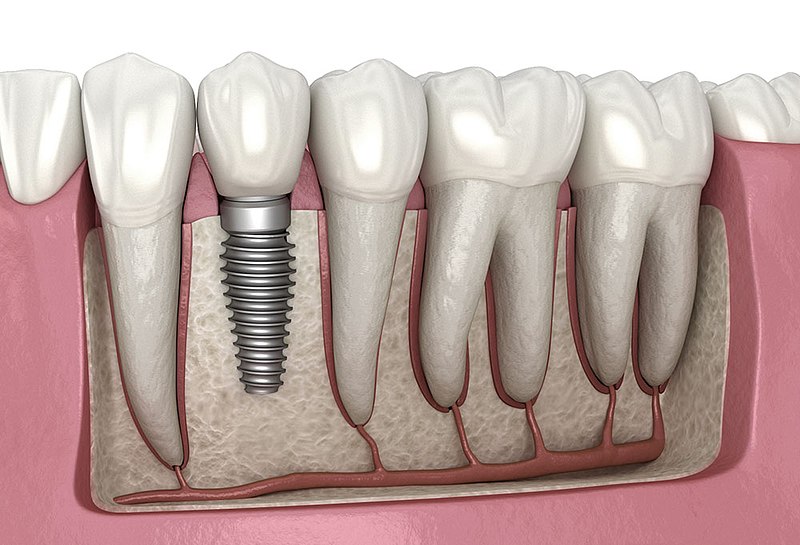 غرسات الأسنان في تركيا 2023 7 Dental Implant Illustration