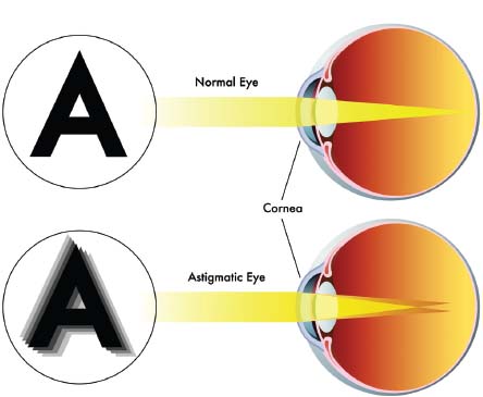 What Is Astigmatism, Treatment Prices In Turkey 2023 11 Eb September A12 Fig5