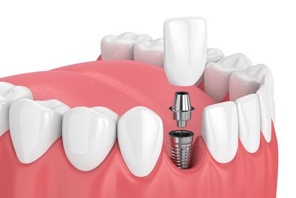 غرسات الأسنان في تركيا 2023 15 Img Dental Implants Perio Gettyimages 931130140