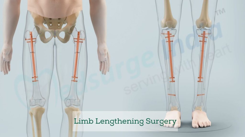 Length Extension Surgery In Turkey 2023 7 Limb Lengthening Surgery