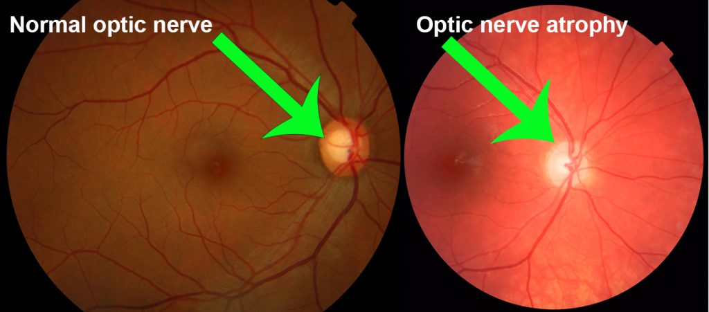 Optic Atrophy Treatment Prices In Turkey 2023 11 Optic Nerve Atrophy1