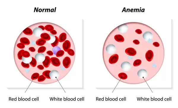 What Is Mediterranean Anemia (Thalassemia)?, Its Symptoms And Treatment In Turkey 2023 6 Px0001As Presentation