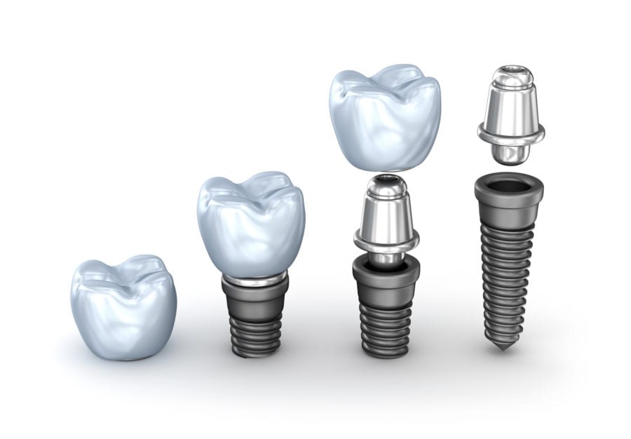 Dental Implants In Turkey 2023 19 Thinkstockphotos 615080464 900X626 1.Bak
