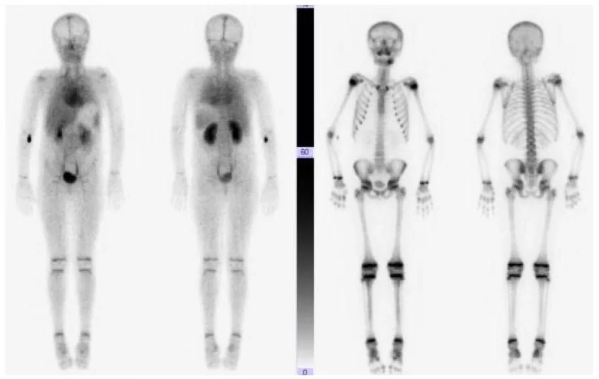 Scintigraphy 2023-Cancer Diagnosis And Treatment 4 Total Body Bone Scintigraphy Showing Increased Blood Flow At The Left Mandibular Bone
