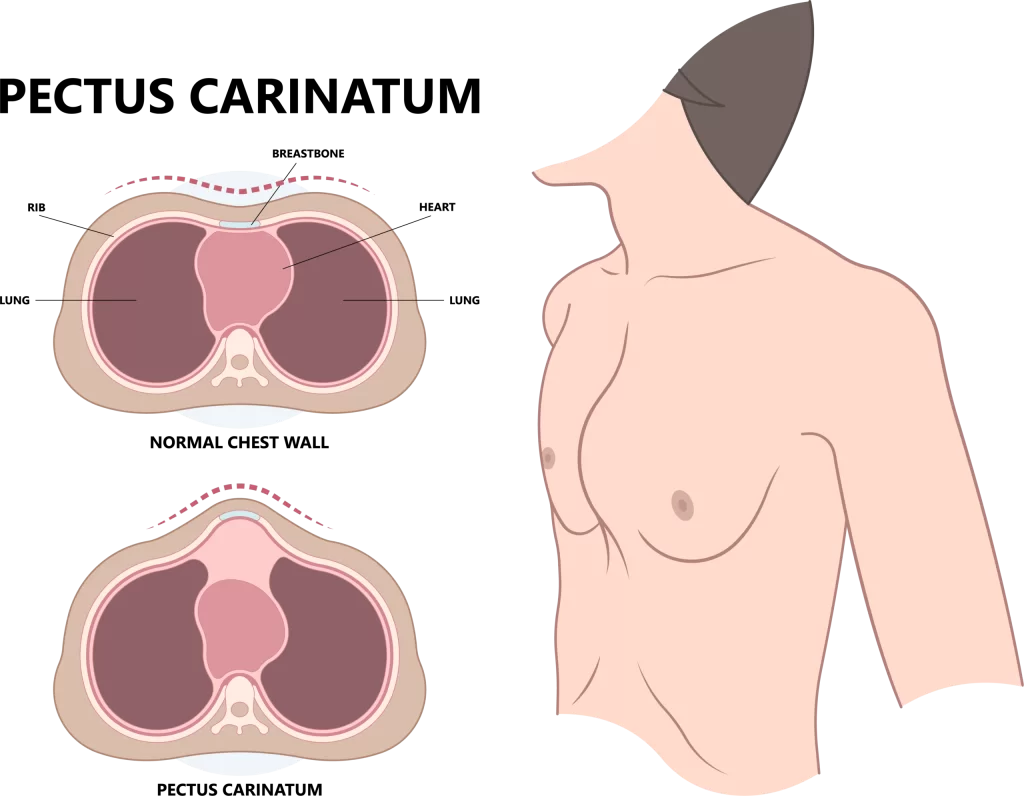 Pectus Carinatum (Pigeon Breast) Treatment 4 Varlik 1