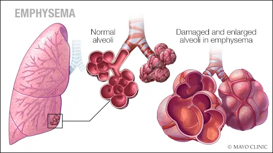 What Is Emphysema? Emphysema Symptoms And Treatment 4 A Medical Illustration Of Emphysema Original