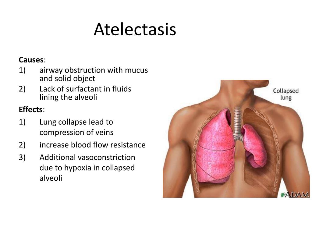 What Is Atelectasis?, Treatment Prices In Turkey 2023 9 Atelectasis L