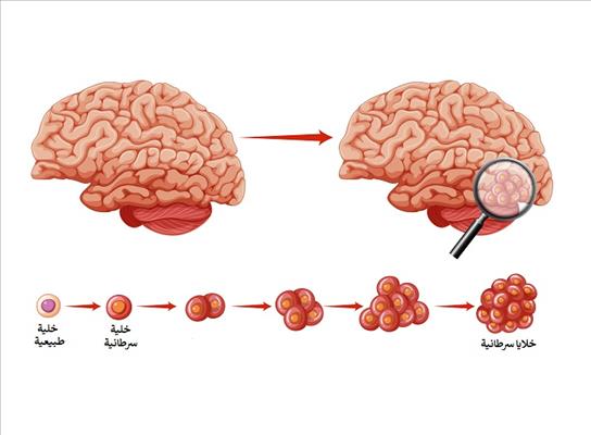 أورام المخ وأنواعها وأعراضها وتشخيصها وطرق علاجها 13 B3B42761 82E2 4Dbd Ba86 0Bf28B32Fd61