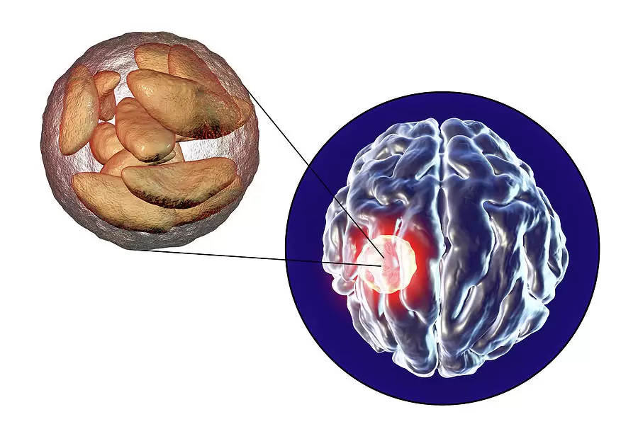 علاج خراج الدماغ في تركيا 2023 3 Brain Abscess Caused By Toxoplasma Gondii Kateryna Konscience Photo Library