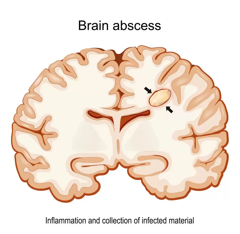 علاج خراج الدماغ في تركيا 2023 1 Brain Abscess Cerebral Cross Section Vector 43079232