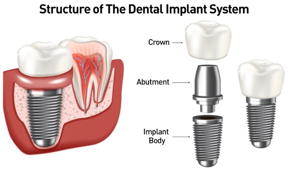 Dental Implants In Turkey 2023 17 Dental Implant System