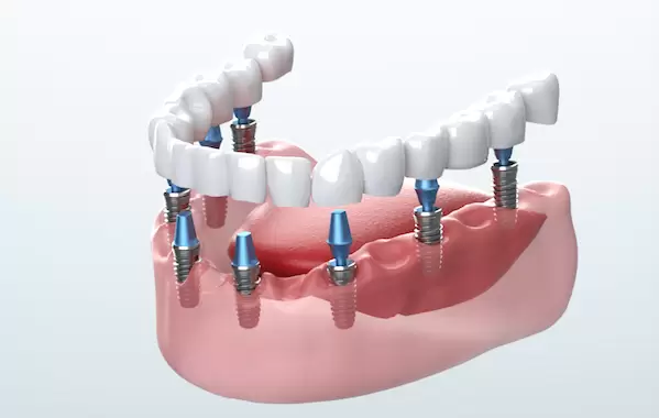 غرسات الأسنان في تركيا 2023 5 Dental Implants 600