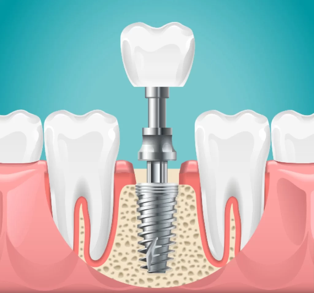 Dental Implants In Turkey 2023 11 Dentalimplants 1920W