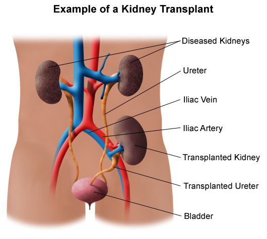Kidney Transplant 4 Example Of Kidney Transplant 125842