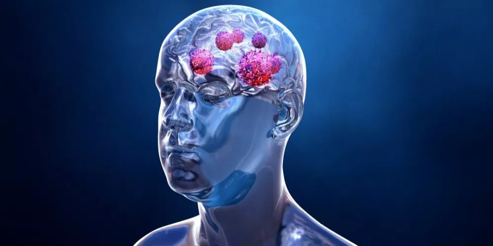 أورام المخ وأنواعها وأعراضها وتشخيصها وطرق علاجها 11 F9D6B2F0092555D735377B944C466E36