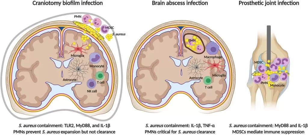 Brain Abscess Treatment In Turkey 2023 11 Fimmu 12 625467 G003
