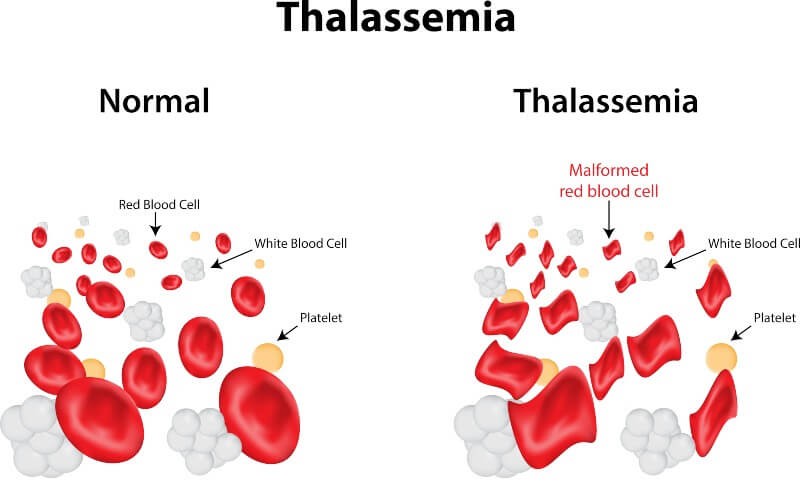What Is Mediterranean Anemia (Thalassemia)?, Its Symptoms And Treatment In Turkey 2023 8 Image