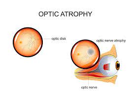 Optic Atrophy Treatment Prices In Turkey 2023 18 Images 2