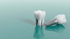 Dental Implants In Turkey 2023 21 Images 5