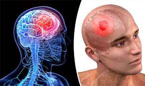 أورام المخ وأنواعها وأعراضها وتشخيصها وطرق علاجها 1 Images 6