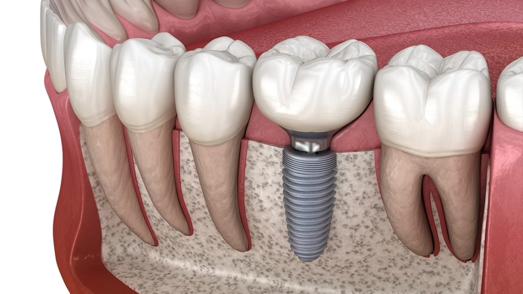 غرسات الأسنان في تركيا 2023 3 Implant Service Graphic