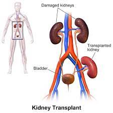 Kidney Transplant 17 Indir 2 2