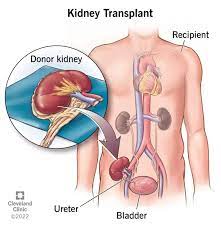 Kidney Transplant 22 Indir 6