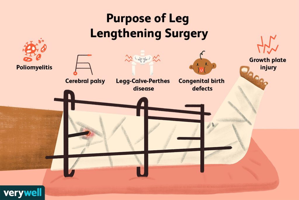 Length Extension Surgery In Turkey 2023 5 Leg Lengthening Surgery 5089136 Final 15528A3B4C6A4Bef85126F62C2415Cb5