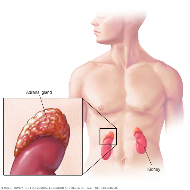 سرطان الغدة الكظرية 3 Mcdc7 Adrenal Glandsthu Jpg