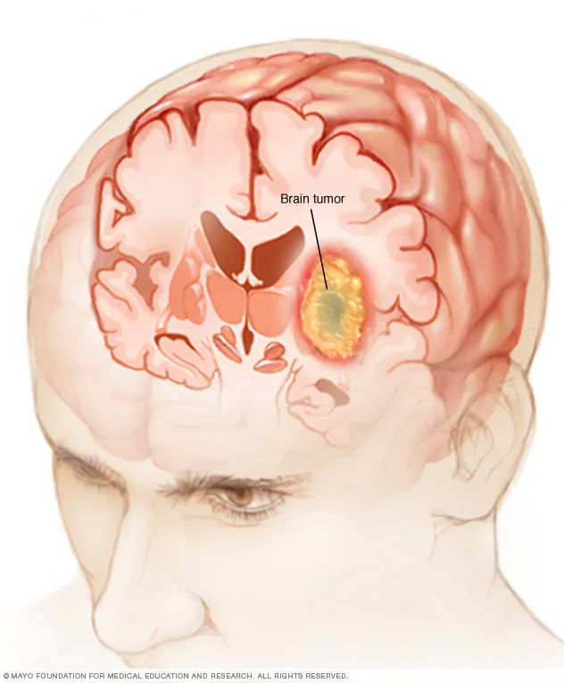 أورام المخ وأنواعها وأعراضها وتشخيصها وطرق علاجها 9 Mcdc7 Brain Cancer 8Col