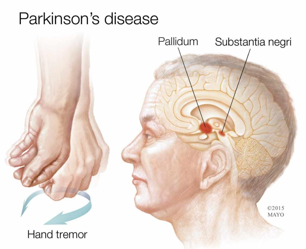 What Is Parkinson'S?, Parkinson'S Disease Cost In Turkey 2023 4 P1Dhbm7O241L191Napetq19Rd1H0A3