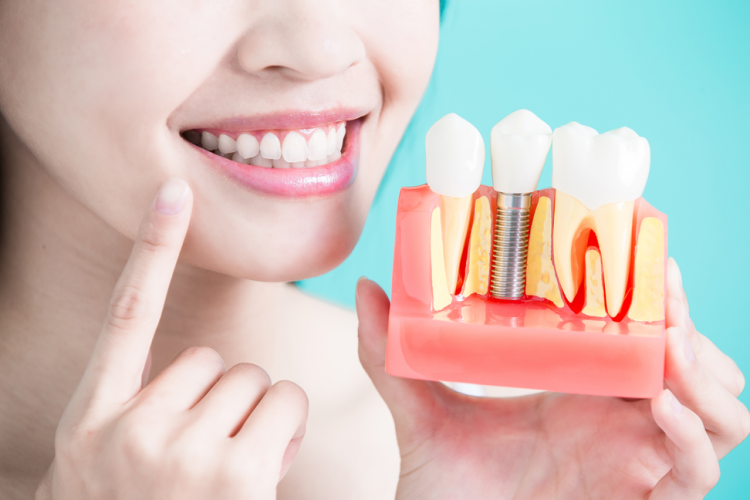 غرسات الأسنان في تركيا 2023 9 Rsz 1Rsz Shutterstock 644475328 E1560237983769.Png