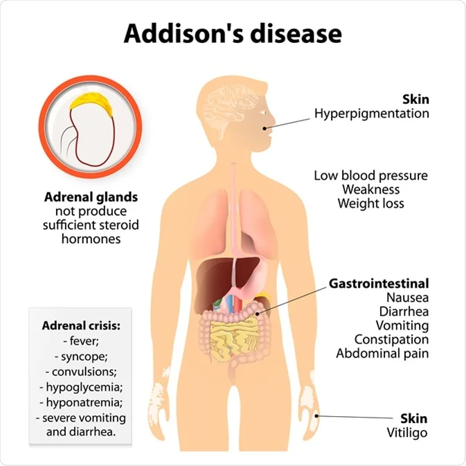 Addison'S Disease, Symptoms And Treatment In Turkey 2023 2 Shutterstock 295238312