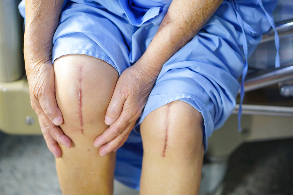 Knee Replacement Surgery 7 Top 5 Mistakes After Knee Replacement
