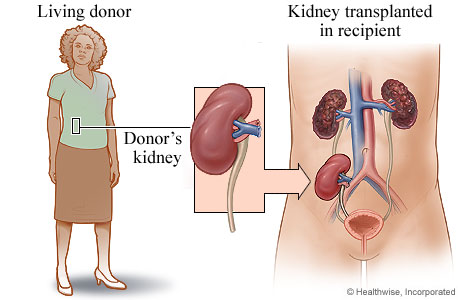 Kidney Transplant 7 Tranplantclinic