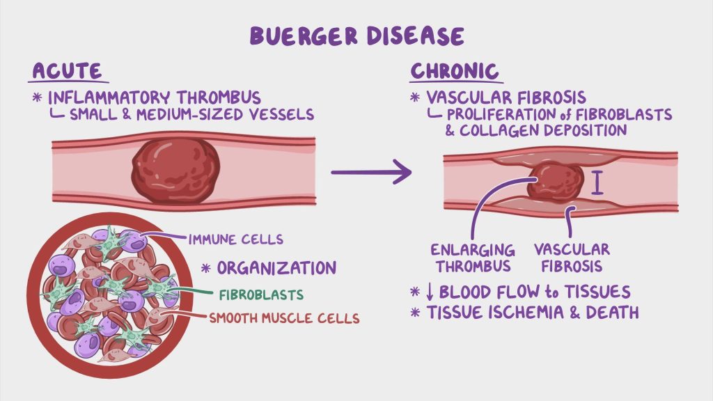 Buerger'S Disease 10 Unnamed File 1
