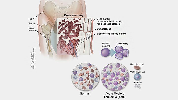 Marrow Transplant 7 What Is Acute Myeloid Leukemia Rm Alt 722X406 1