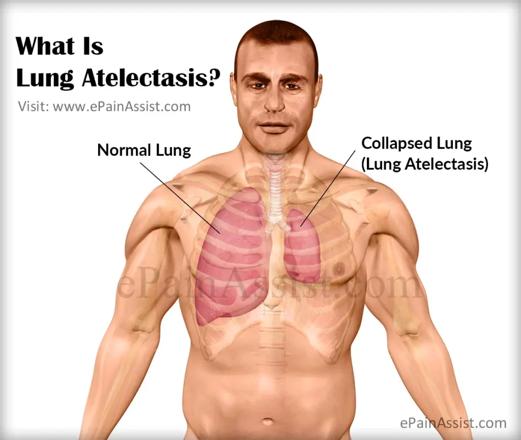 What Is Atelectasis?, Treatment Prices In Turkey 2023 5 What Is Lung Atelectasis Preview