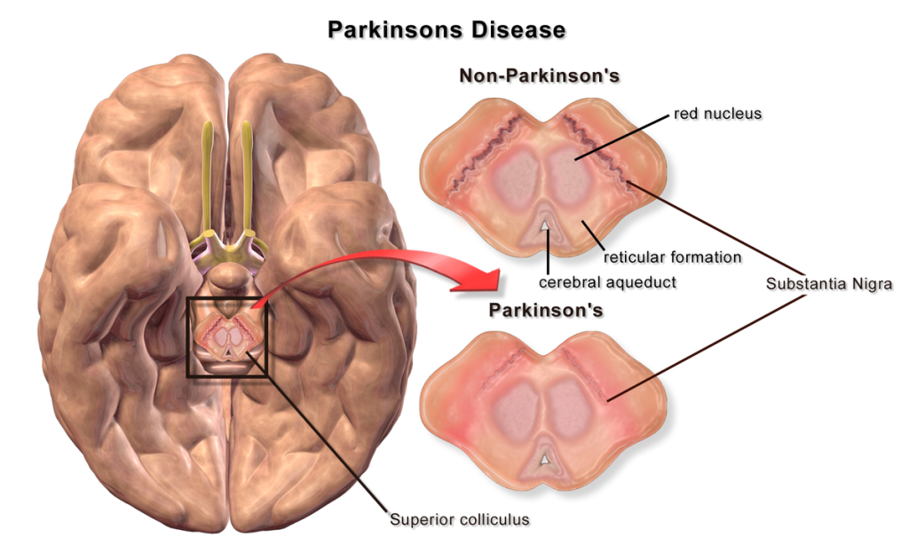 مرض باركنسون ( الشلل الرعاش) 1 Blausen 0704 Parkinsonsdisease