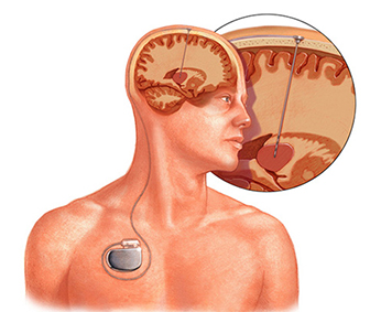 ما هي بطارية الدماغ (التحفيز العميق للدماغ في مرض باركنسون)؟ 1 Beyin Pili 3 1